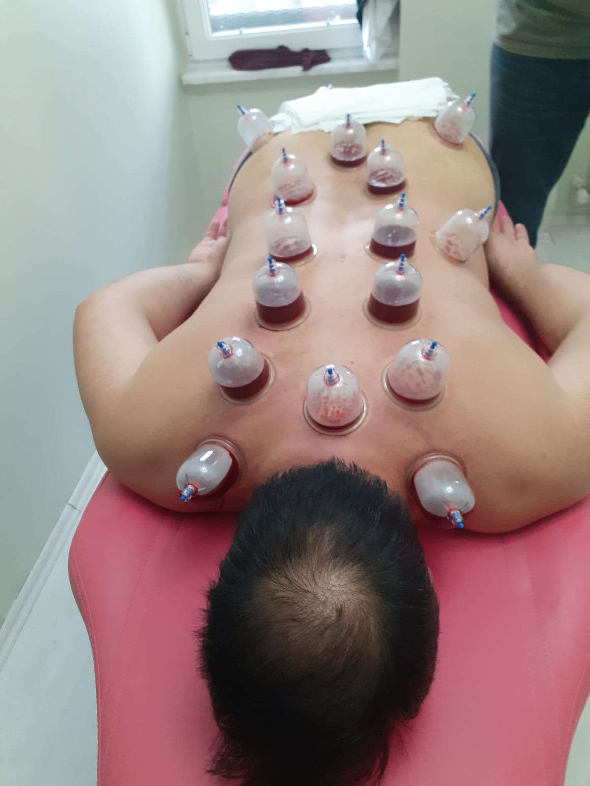Hacamat tedavisi - Cupping therapy session