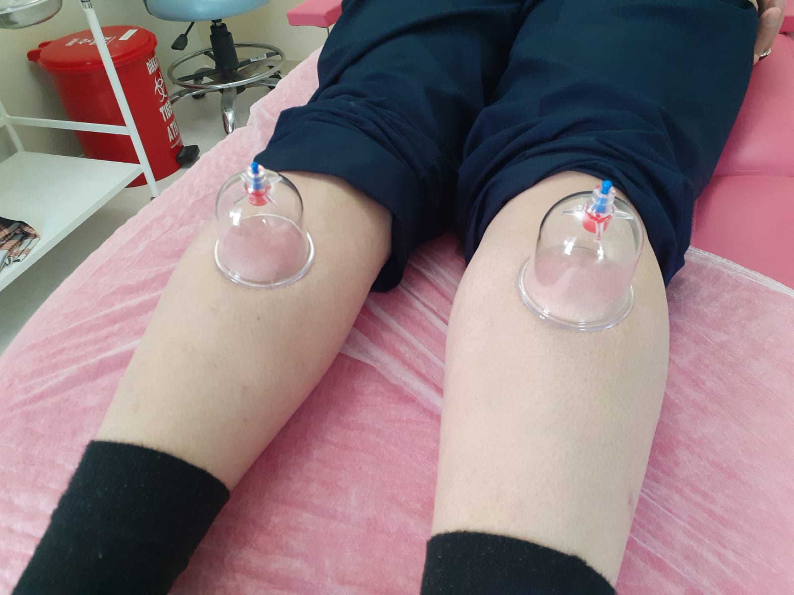 Hacamat tedavisi - Bacak tedavisi